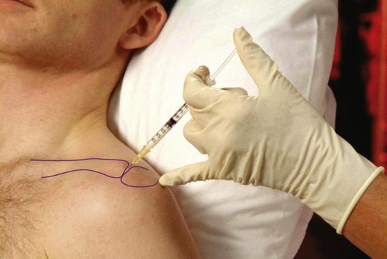 Тобольские травматологи лечат плечевой сустав на новый лад